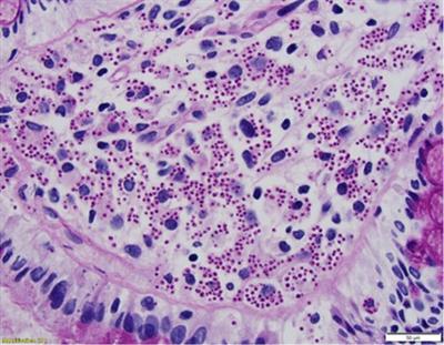 Case report: Disseminated histoplasmosis in a renal transplant recipient from a non-endemic region